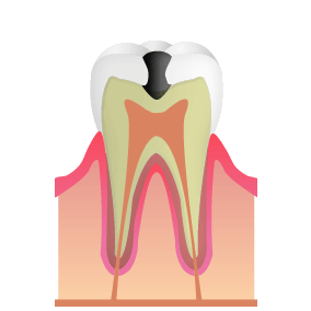 C2:細菌が象牙質に到達した虫歯