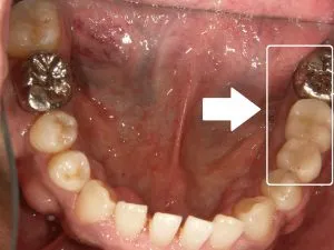 1/1.7 , Dental3