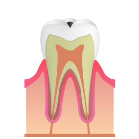 C1:細菌がエナメル質に到達した虫歯