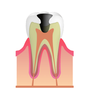 C3:細菌が神経に到達した虫歯
