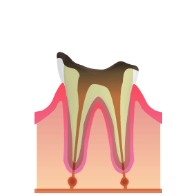 C4:細菌が歯の根まで到達した虫歯