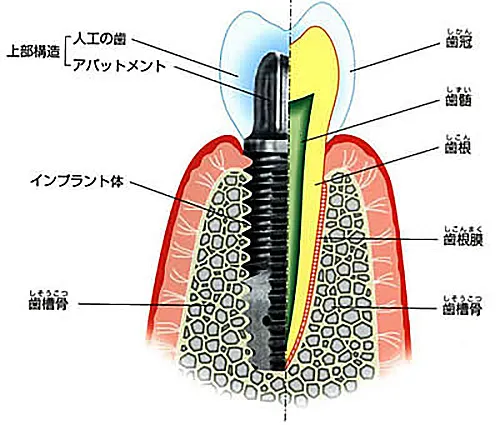 インプラントの構造